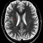 Clustered T2 hyperintense cystic structures in the subcortical white matter of the right frontal operculum and superior insula (red arrow) with normal appearance of the overlying cortex which is a typical appearance for MVNT.