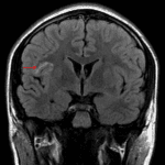 This lesion remains hyperintense on FLAIR (red arrow).