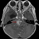 Heterogeneous areas of internal enhancement, including in the prepontine tumor component (red arrow).