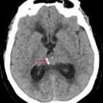 A pineal region mass with peripheral calcification (red arrow) is identified on CT.