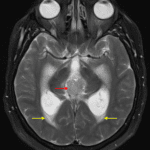 The mass demonstrates intermediate T2 signal intensity (red arrow). There is associated obstructive hydrocephalus with subependymal edema (yellow arrows).
