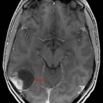Mixed solid and cystic mass centered in the posterior right temporal lobe (red arrow) with adjacent broad dural contact.