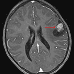 Mixed cystic and solid tumor in the inferior left frontal lobe (red arrow).