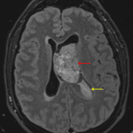 Mildly FLAIR hyperintense mass in the left lateral ventricle abutting the septum pellucidum (red arrow). Hyperintense material layering in the left lateral ventricle likely representing hemorrhage (yellow arrow).