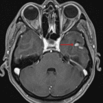Small, mixed cystic and solid lesion in the inferior left temporal lobe with avid enhancement of the solid components (red arrow).