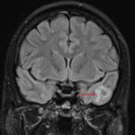 Minimal surrounding edema and mass effect (red arrow), which is typical for gangliogliomas.