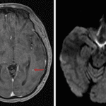 Additional masslike area of restricted diffusion in the posterior left temporal lobe with a nodular focus of enhancement along its anterior margin (red arrows).