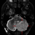 Mildly T2 hyperintense left cerebellar mass with striated internal architecture (red arrows), which is a classic appearance for a dysplastic cerebellar gangliocytoma.