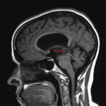 T1 hypointense pineal region mass (red arrow) with downward mass effect on the tectum and associated obstructive hydrocephalus.