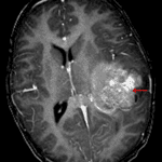 Heterogeneously enhancing mass in the left cerebral hemisphere (red arrow) with associated local mass effect and midline shift.