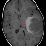 Area of T1 signal hyperintensity along the deep margin of the tumor (red arrow), likely representing tumor-related hemorrhage.
