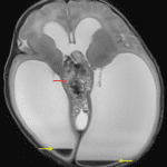 Heterogeneous midline mass (red arrow) with associated severe obstructive hydrocephalus and small volume intraventricular hemorrhage (yellow arrows).