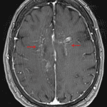 Curvilinear and nodular enhancement tracking along perivascular spaces in the bilateral cerebral white matter (red arrows) in this patient with intravascular lymphoma.