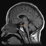 Thickening of the pituitary stalk (red arrow) with absent posterior pituitary T1 bright spot (yellow arrow).