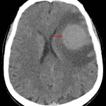 Hyperattenuating mass on CT (red arrow) with surrounding vasogenic edema.