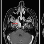 Multiple enhancing mass involving the right skull base (red arrow), right nasolacrimal duct (yellow arrow), and left nasal cavity (blue arrows).