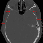 Multiple areas of calvarial thinning (red arrows), likely the result of longstanding elevated intracranial pressure.
