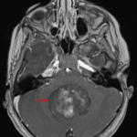 Heterogeneously enhancing mass centered in the vermis and fourth ventricle (red arrow).
