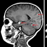 Multiple T1 hyperintense lesions scattered along the surface of the brain and brainstem (red arrows) in this patient with neurocutaneous melanosis.
