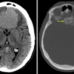 Typical CT appearance of an olfactory groove meningioma, which is hyperattenuating relative to the brain parenchyma (red arrow) and demonstrates adjacent hyperostosis (yellow arrow).