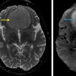 Typical MRI appearance of an olfactory groove meningioma, which is relatively isointense on T1 (red arrow) and T2 (yellow arrow) and demonstrates restricted diffusion (blue arrows).