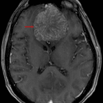 Internal spoke-wheel vascularity on postcontrast imaging (red arrow).