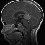 Enhancing pineal region mass (red arrow) with downward mass effect on the tectum (yellow arrow).