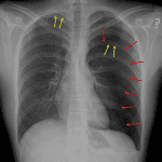 Left pneumothorax with the visceral pleural margin indicated by the red arrows. Subtle small bilateral apical pleural blebs, indicated by the yellow arrows.