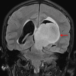 Large, relatively homogeneous T2/FLAIR hyperintense mass centered in the left thalamus (red arrow), consistent with a diffuse midline glioma.