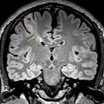 Abnormal cortical thickening and T2/FLAIR signal hyperintensity (red arrow) with blurring of the gray-white junction and a band of T2/FLAIR signal hyperintensity extending to the underlying ventricular margin (yellow arrow).