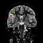 Abnormal cortical and juxtacortical T2 signal hyperintensity involving the right inferior frontal gyrus (red arrow) with an adjacent transmantle sign (yellow arrow).