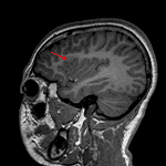 Associated blurring of the gray-white interface on T1 (red arrow).