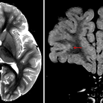 Nonexpansile T2/FLAIR hyperintense lesion involving the juxtacortical white matter and cortex of the inferior right frontal lobe with a projection of signal hyperintensity extending into the deep white matter (red arrows).