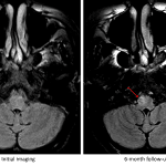 Development of T2/FLAIR signal hyperintensity and enlargement of the right inferior olivary nucleus at 6 month followup imaging (red arrow).
