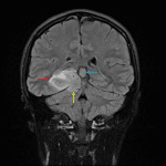 Solid mass in the medial right temporal lobe (red arrow), which bulges inferiorly through the tentorial notch (yellow arrow). Note that there is partial internal signal suppression on FLAIR compared to T2. Incidental pineal cyst (blue arrow).