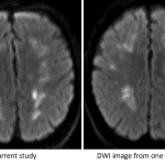 Persistence of restricted diffusion in the cerebral white matter over a one month interval, which is not typical for ischemic infarcts resulting from a single event.