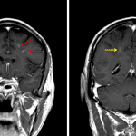 Corresponding areas of enhancement in the frontal lobes (red arrows) and to a lesser extent in the parietal lobes (yellow arrows).