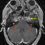 Bilateral vestibular schwannomas (red arrows). Enhancement in the left Meckel's cave extending into the foramen ovale (yellow arrow), also likely a schwannoma.