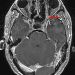 Enhancement in the left orbital apex along the optic nerve (red arrow), likely representing an optic nerve sheath meningioma.
