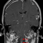 Enhancing intramedullary lesions in the upper cervical spinal cord (red arrows), likely representing ependymomas.