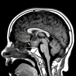 Heterogeneous suprasellar mass (red arrow) which is seen separate from the pituitary gland (yellow arrow).