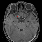 Enlargement of the right greater than left prechiasmatic optic nerves (red arrows), consistent with optic pathway glioma in this patient with NF-1.
