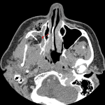 Herniation of retroantral fat through the right maxillary sinus wall fracture (red arrow).