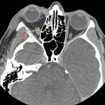 Minimally displaced fracture through the right zygomaticosphenoid suture (red arrow) with a thin adjacent extraconal hematoma (yellow arrow) and associated mild proptosis.