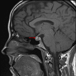 T1 hyperintense lesion along the superior margin of the pituitary gland (red arrow).