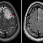 The T2-FLAIR mismatch sign: the lesion demonstrates internal T2 signal hyperintensity (red arrow) contrasted to relatively hypointense FLAIR signal (yellow arrow).