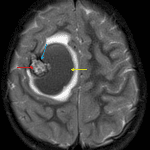 Lesion in the right frontal lobe with heterogeneous internal T2 signal intensity (red arrow), a rim of T2 signal hypointensity (blue arrow), and an adjacent hematoma (yellow arrow) with surrounding edema.