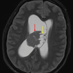 Mass in the body of the right lateral ventricle with a solid component laterally (red arrow) and a cystic component medially (yellow arrow).