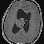 Internal patchy areas of enhancement (red arrows).