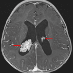 Enlargement of the right greater than left choroid plexus in the lateral ventricles (red arrows).